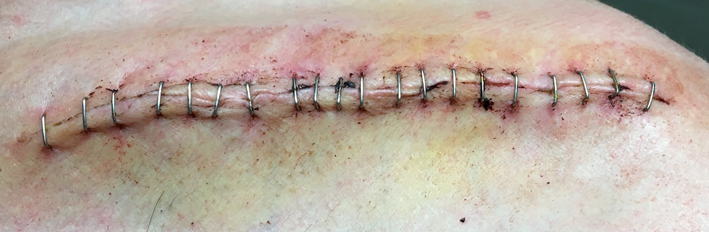 Selon le chirurgien, une suture à l’agrafe cicatrise mieux…