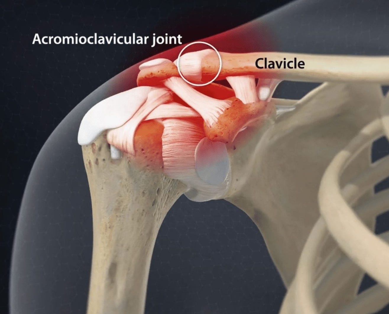 Le ligament acromio-claviculaire relie l’os de la clavicule à l’acromion, une partie de l’omoplate. Une luxation de stade 2 signifie une déchirure partielle ou une élongation de ce ligament